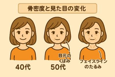 骨密度の変化による見た目の変化を示すイラスト。40代の女性は顔に変化なし、50代は目元にくぼみが見られ、60代ではフェイスラインがたるんでいる。